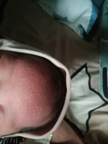 Anaku beruntusan seperti ini , ada yg pernah ngalamin gak bunda² ? Cara ngobatin nya gmna ya?