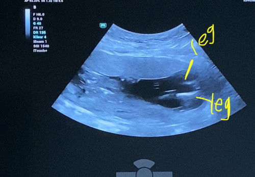 Babys’ gender 14 weeks