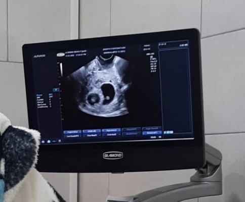 Sharing hasil USG bayi kembar