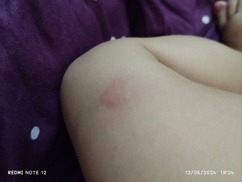 Digigit serangga apa ya?