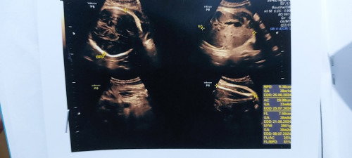 AC/Lingkar perut janin berdasarkan hasil usg lebih kecil