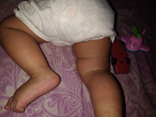 Ini campak bukan ya ?