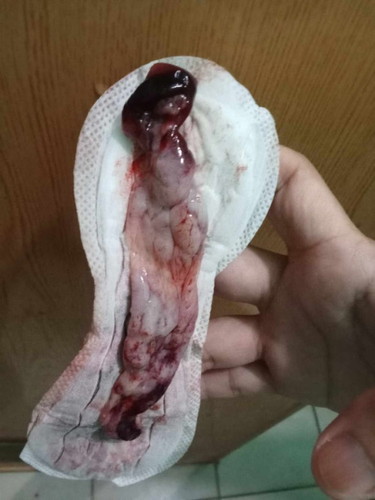 Normal po ba ito during first menstruation after cs? 3months c baby nung may 28.