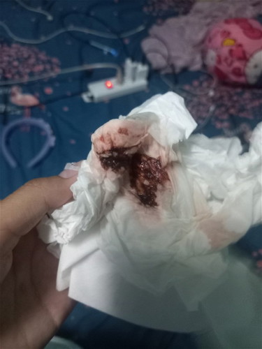 5w1d มีเลือดออกสีแบบนี้