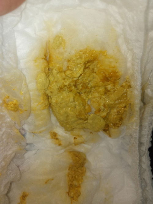 Bayi 10 bulan sering bab