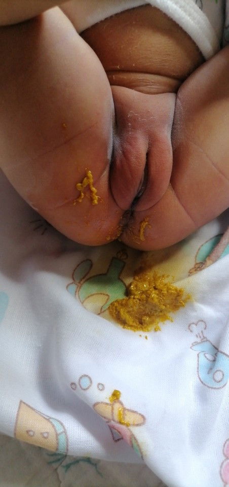 ลูกกินนมแม่แล้วถ่ายบ่อย