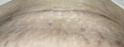 Luka setelah SC 3 Minggu