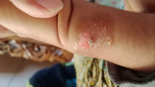 Kulit bayi seperti terbakar