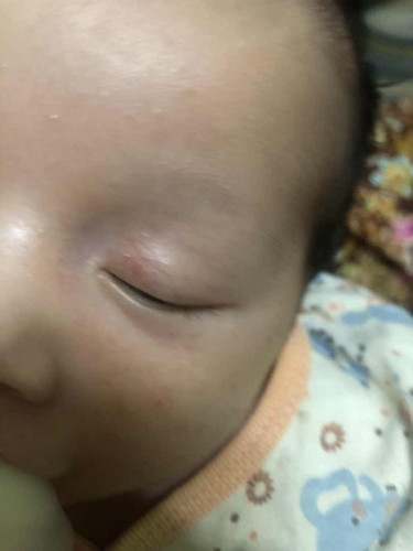 Kelopak mata bayi merah