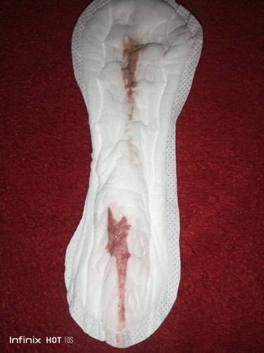 Vaginal discharge