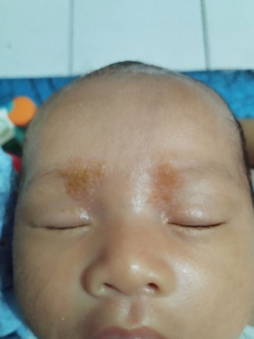 Beruntusan di wajah baby