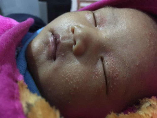 bintik bintik pada bayi newborn