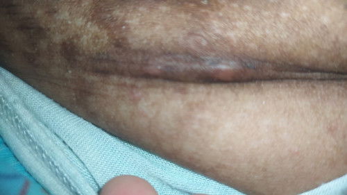 Luka sc belum kering