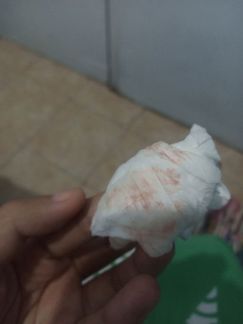 Perdarahan di 27 minggu