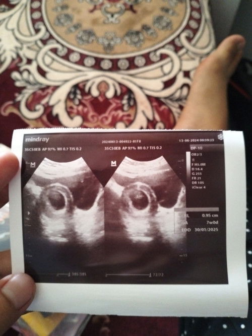 Usia kehamilan 7week 
Baru kelihatan janin nya 
Belum ada djj nya normal ngga ya Bun??