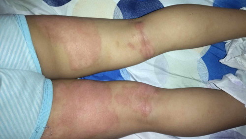 Skin allergy