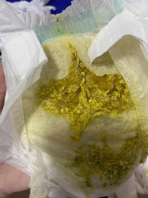 สีอุจาระเด็กทารก