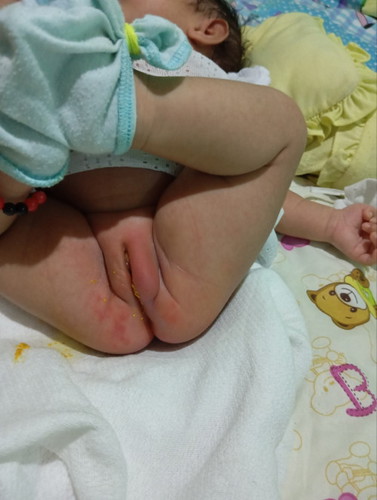 Diaper rash