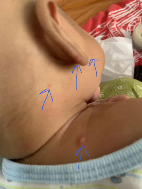 Allergic or Chicken Pox