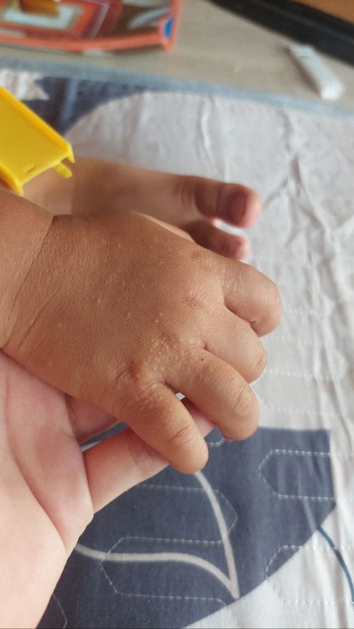 Gatal tapi tidak gatal