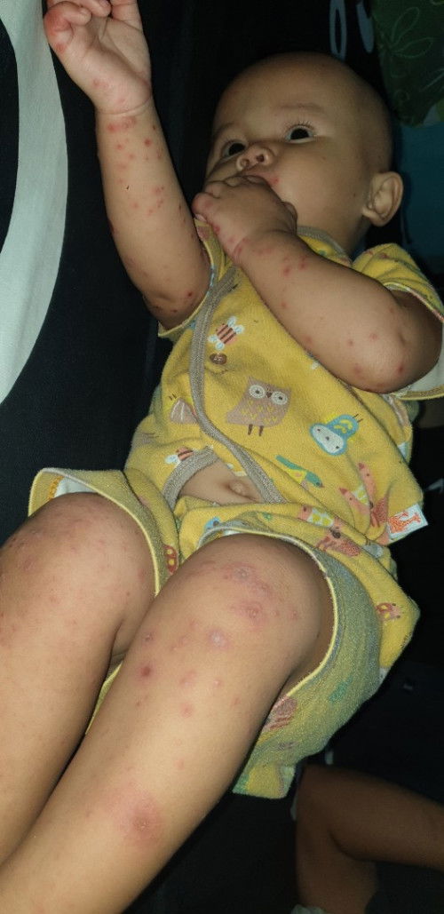 Bintik merah cacar air atau yg lain?