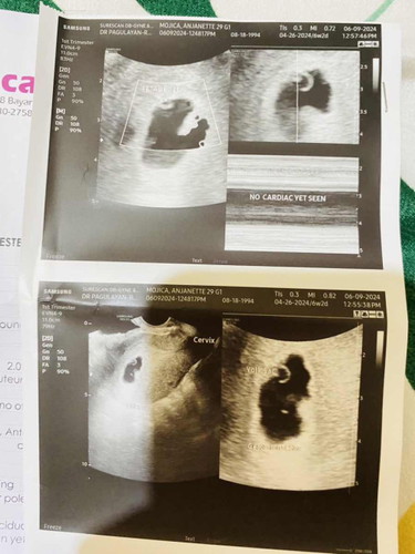 GESTATIONAL SAC IRREGULAR SHAPED