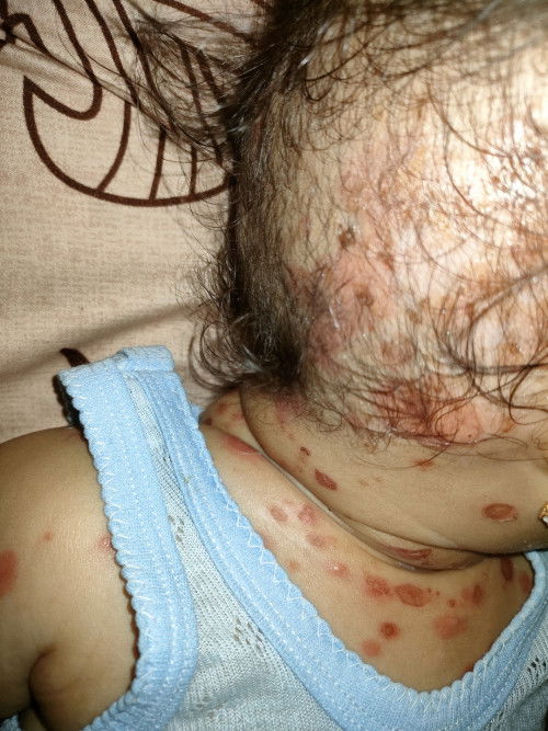 Ada yg anaknya pernah sakit ini bun? Kulit merah mengelupas dan menyebar