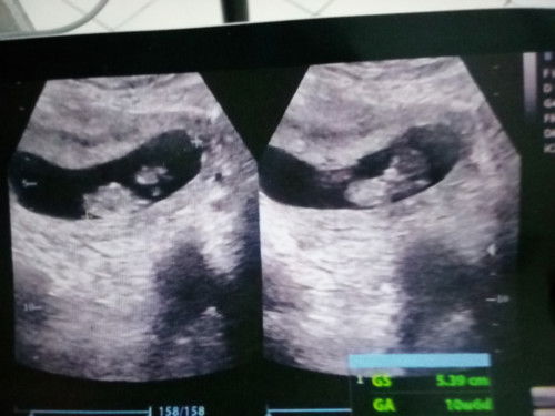 Kehamilan 10w6d seharusnya 8w4d