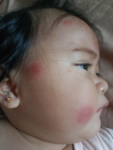 insect bite na lumalaki ang pamumula