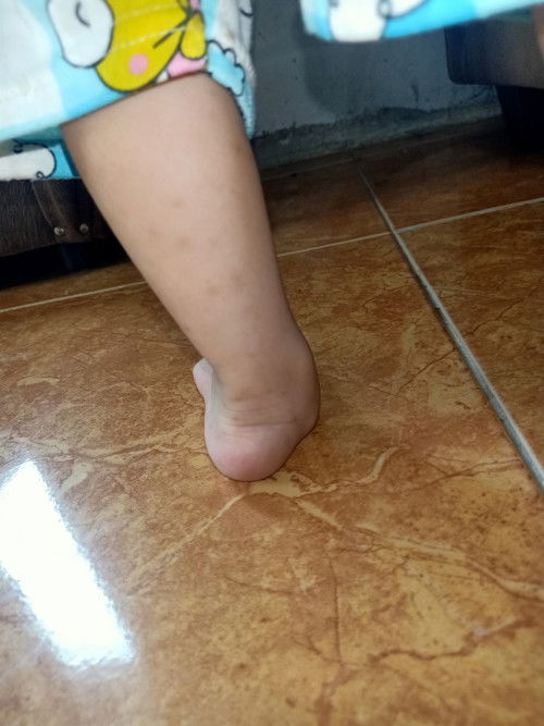 Kaki anak bermasalah