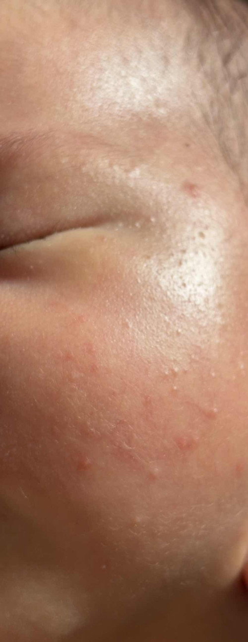 ผื่นแบบนี้ผดร้อนใช่ไหมคะ