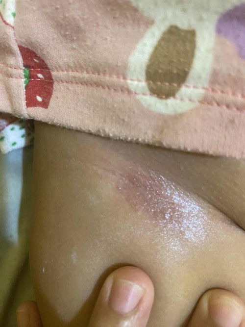 Merah merah di bagian selangkangan saat dipegang nangis