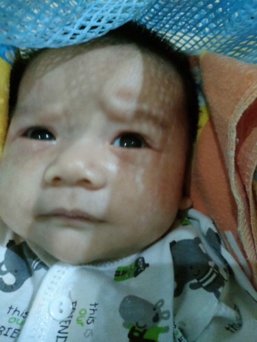 anak sy kena ruam di pipi & ke2 matanya, sy pkai bemee balm tp udah 3 hri gk ad perubahan bgmanaini?