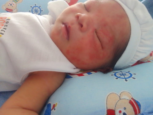 Baby Acne, What to do?