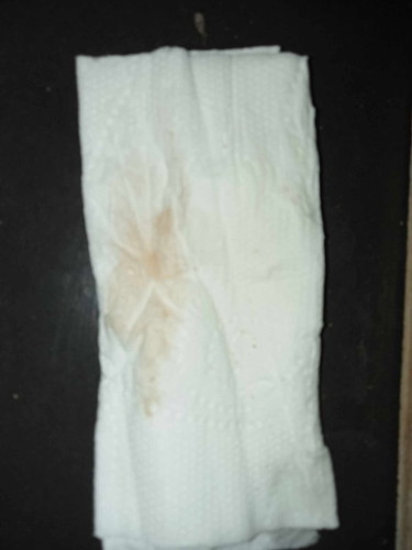 INPLANTATION or Mens po?
Parang light brown na malapit. Konti