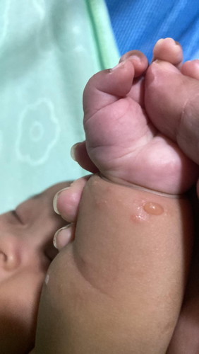 ลูกชายอายุ3เดือนมีตุ้มน้ำพองใส
