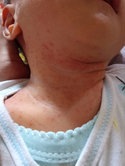 Newborn 14 hari kenapa gini ya leher nya