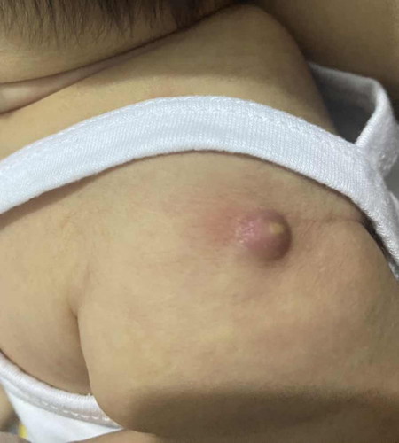 Vaccine scar