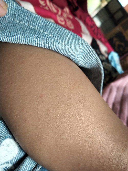 Anak Saya Lagi Demam Udh 2hari Hari ke 2 muncul bintik merah merah kecil itu knp ya?Ada di kaki tgn(