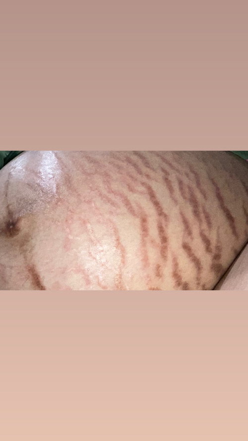 stretchmarks