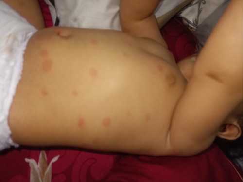 ruam merah di badan anak...macam mana ya nak hilangkn..sy pn x sure ni apa