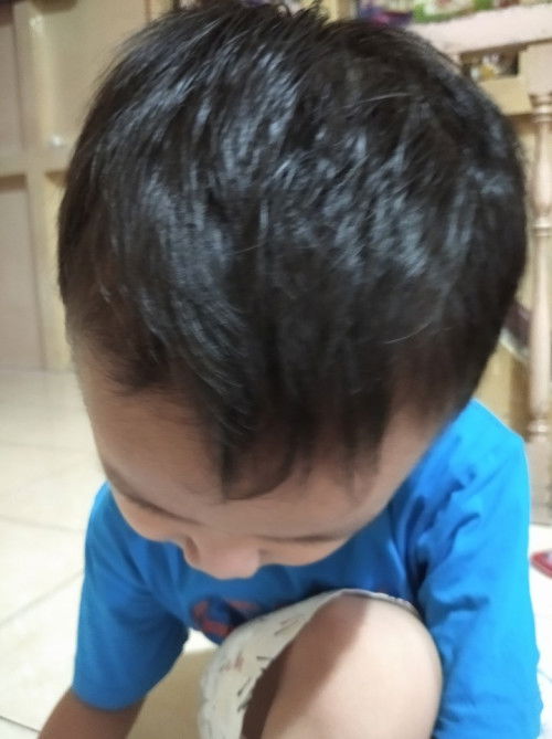 Rambut rontok pada anak 5 thn
