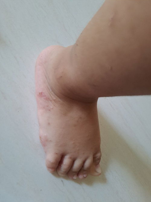 bintik kecil berair pada kaki, tangan, dan muka anak