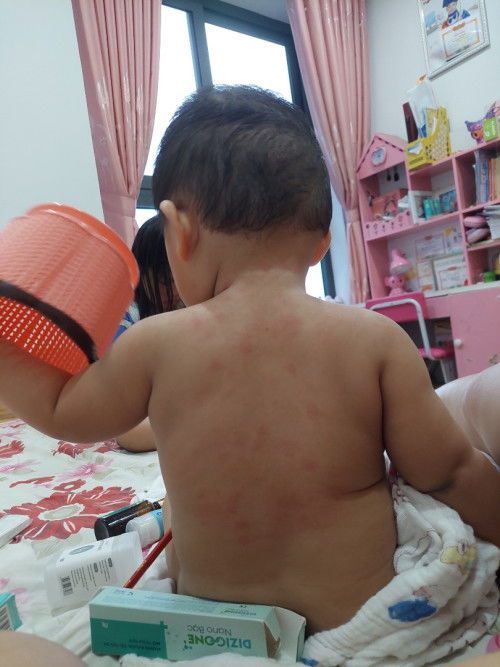 Bé gần 10 tháng bị rôm sảy