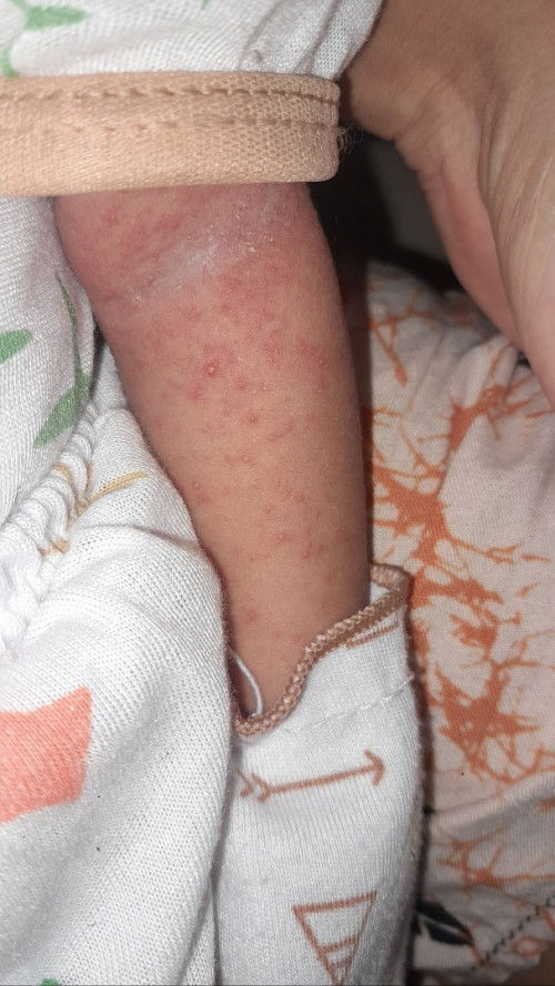 Ruam merah di lengan ,dada dan betis