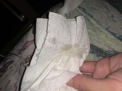 Smelly discharge 35 weeks pregnant