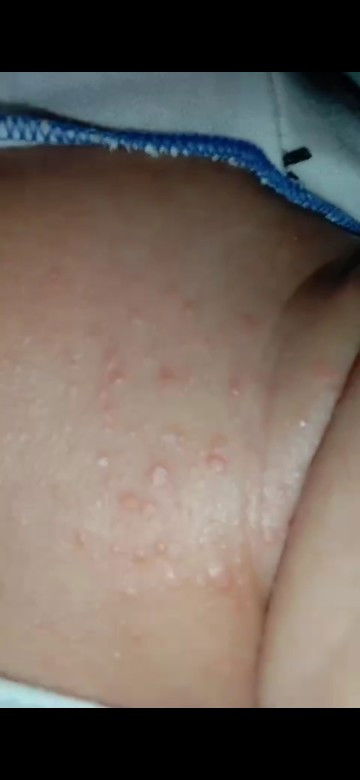 Bintik2 merah dileher