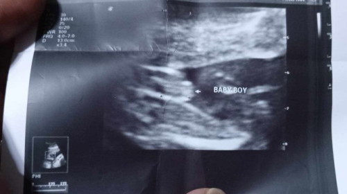 Gender ultrasound
