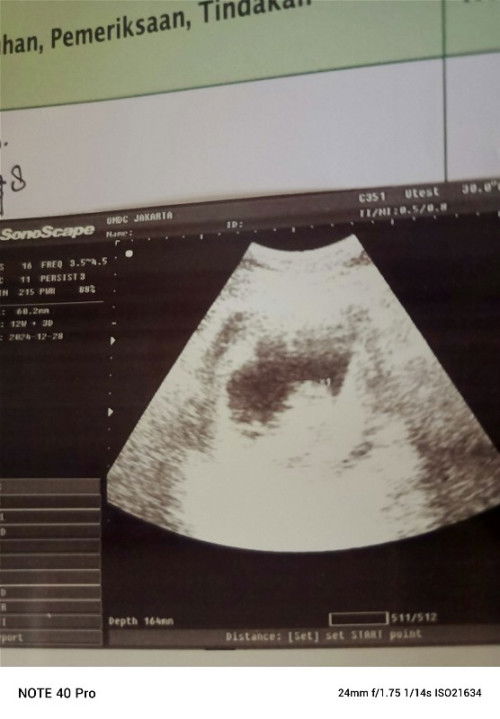 Kantung ketuban tidak bulat