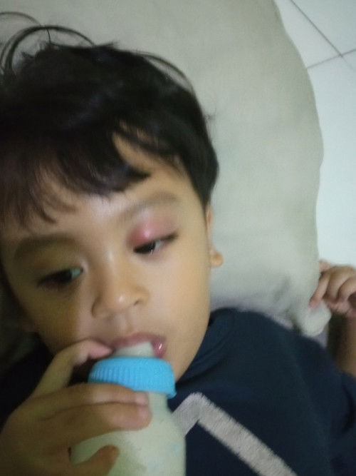 Mata merah dan bengkak